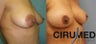 Mastopexy