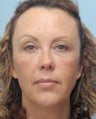Facial Dermafillers