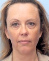 Facial Dermafillers