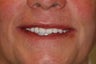 62 year old male treated with All-on-4 Dental Implant Procedure