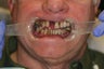 62 year old male treated with All-on-4 Dental Implant Procedure