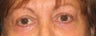 Blepharoplasty