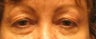 Blepharoplasty