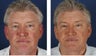 Male Patient Blepharoplasty
