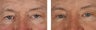 Male Patient Blepharoplasty