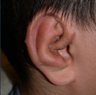 Microtia- ear reconstruction for kids by Dr Kasrai, Toronto Female Plastic Surgeon