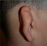 Microtia- ear reconstruction for kids by Dr Kasrai, Toronto Female Plastic Surgeon