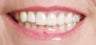 Restoration with Porcelain Veneers