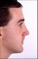 Male rhinoplasty