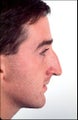 Male rhinoplasty