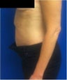 Laser Liposuction