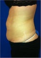 Laser Liposuction
