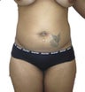 6 Month Post Operative Liposuction