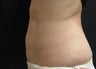 Coolsculpting