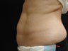 Coolsculpting