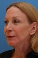 Facelift and Facial Fat Injections