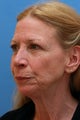 Facelift and Facial Fat Injections