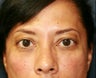 Radiesse to fill lower eyelid hollows