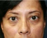 Radiesse to fill lower eyelid hollows