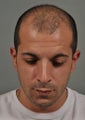 FUE Hair Transplant