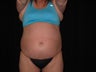 46 Year Old Female Treated with Smartlipo