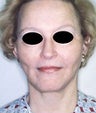 Female patient who underwent liposuction