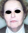 Female patient who underwent liposuction