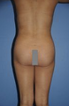 Fat Transfer