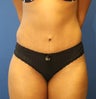 Abdominoplasty (Tummy Tuck) for 34 Year Old Female