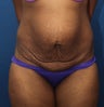 Abdominoplasty (Tummy Tuck) for 34 Year Old Female