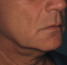 Ulthera