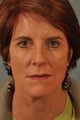 Eyelid Surgery