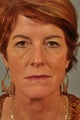 Eyelid Surgery