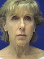 Facelift and Necklift