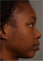 31 year old african american female with weak chin would like non surgical treatment