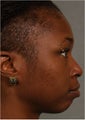 31 year old african american female with weak chin would like non surgical treatment