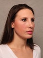 Chin Implant