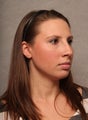 Chin Implant