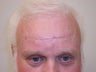 Forehead Lift
