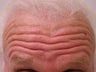 Forehead Lift