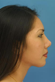 Ethnic Rhinoplasty