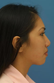 Ethnic Rhinoplasty