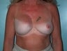 Female patient who underwent breast reconstruction