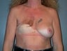 Female patient who underwent breast reconstruction