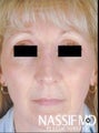 Female Revision Rhinoplasty