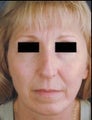 Female Revision Rhinoplasty