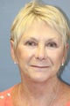 LiteLift™, Platysmaplasty and Lower Pinch Blepharoplasty on 70-year-old Women