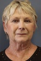 LiteLift™, Platysmaplasty and Lower Pinch Blepharoplasty on 70-year-old Women