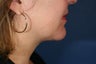 46 Year Old Female Liposuction