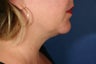 46 Year Old Female Liposuction